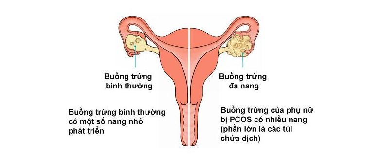 Vô sinh Hiếm muộn 1 Buồng trứng bình thường và buồng trứng của phụ nữ bị PCOS