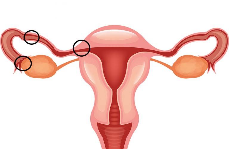 Các bệnh phụ khoa thường gặp hiện nay và cách phòng tránh 4 Dấu hiệu cảnh báo viêm tắc vòi trứng