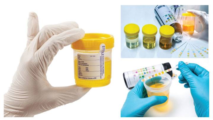 Những điều mẹ bầu cần biết về xét nghiệm sàng lọc 3 tháng đầu 2 Xét nghiệm nước tiểu trong 3 tháng đầu thai kỳ